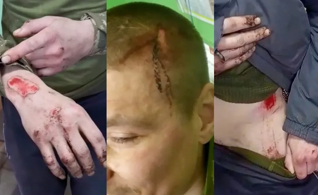 Рани на руках, голові та боці бійців після знущань у полку «Скеля»